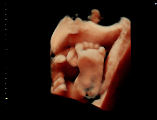3D ultrasound image at 29 weeks